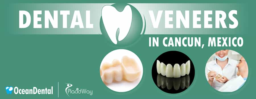 Dental Veneers in Cancun, Mexico