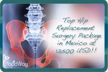 Affordable Hip Replacement Surgery Package at Mexicali, Mexico