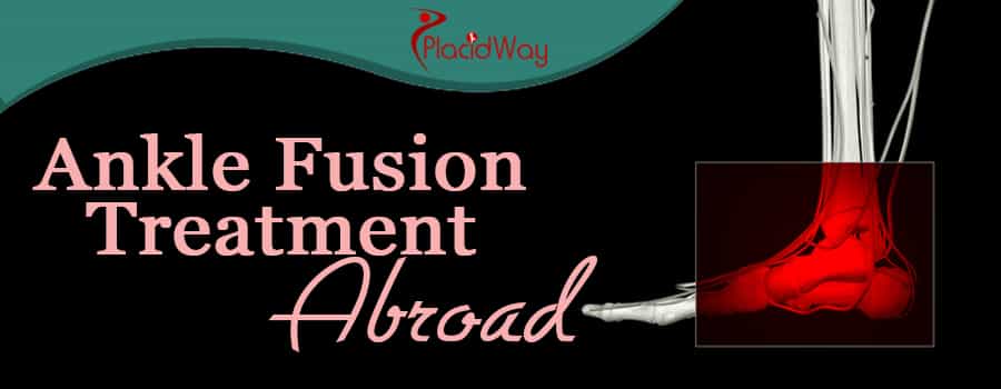Ankle Fusion Treatment Abroad