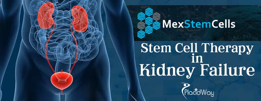 MexStemCells Clinic Stem Cells Therapy in Kidney Failure - Mexico