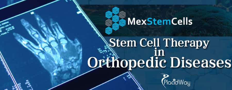 MexStemCells Clinic Stem Cell Therapy for Rheumatoid Arthritis - Mexico