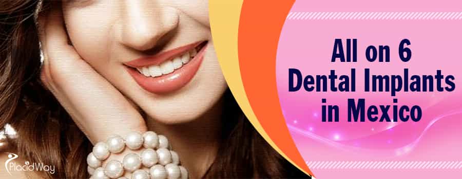 Best All on 6 Dental Implant Packages, Top Dentist in Mexico