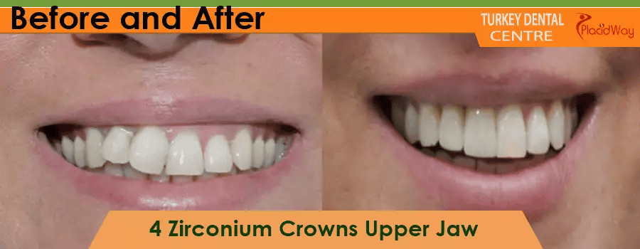 Before and After Zirconium Crowns in Turkey