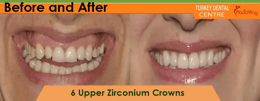 Before and After Zirconium Crowns in Turkey