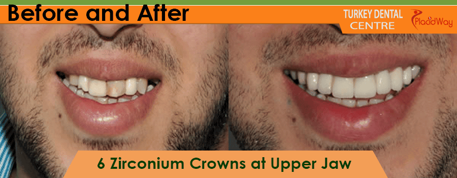 Zirconium Crowns Before and After Results Antalya Turkey