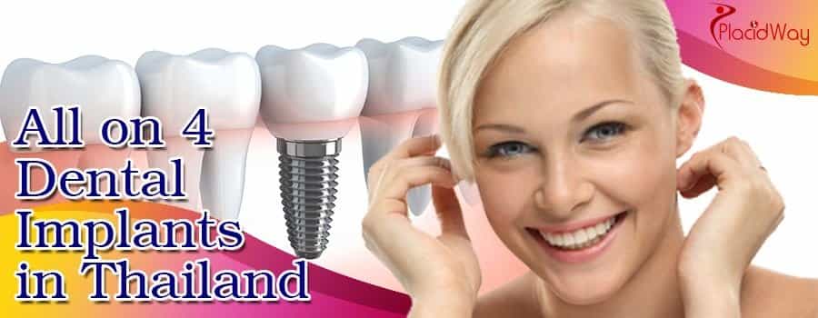 Best All on 4 Dental Implants in Thailand