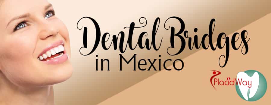 Affordable Dental Bridges Packages in Mexico