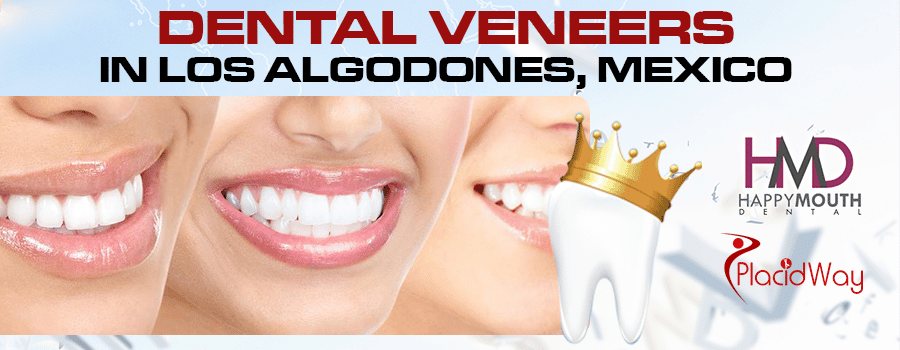 High Quality Dental Veneers Package in Los Algodones, Mexico