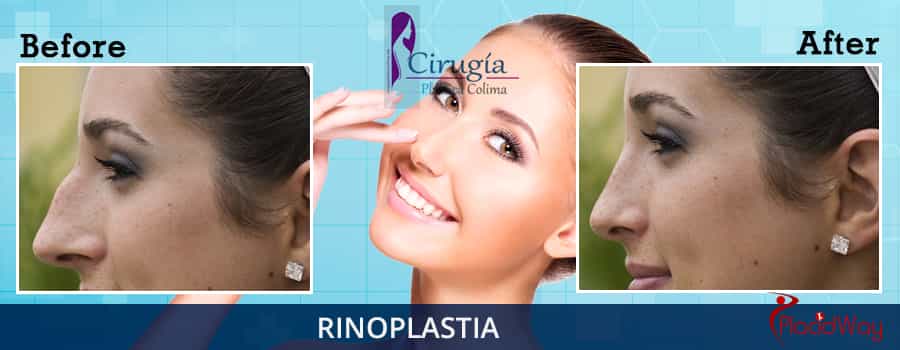 Before and After Rhinoplasty in Mexico