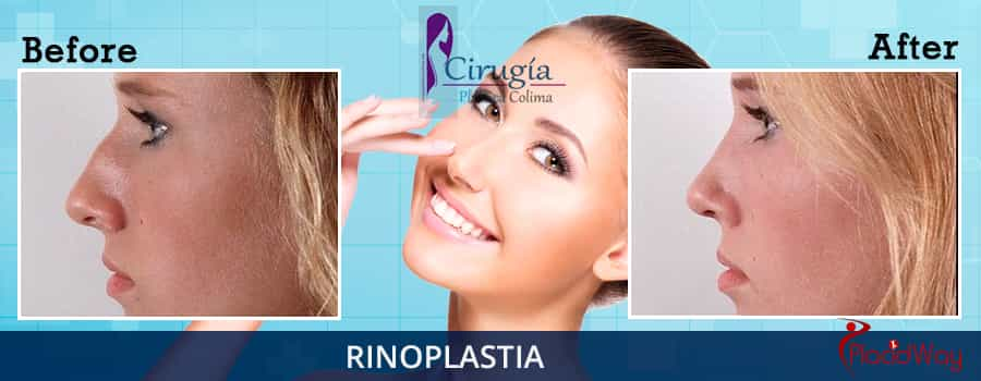 Before and After Rhinoplasty in Mexico