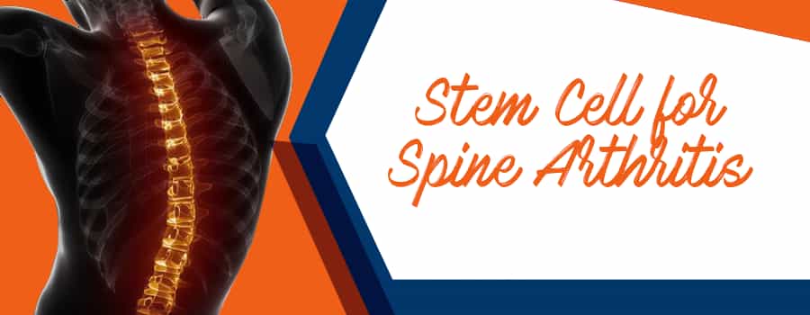 Stem Cell Therapy for Spine Arthritis