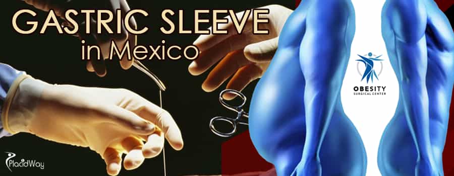 Gastric Sleeve Package in Mexico