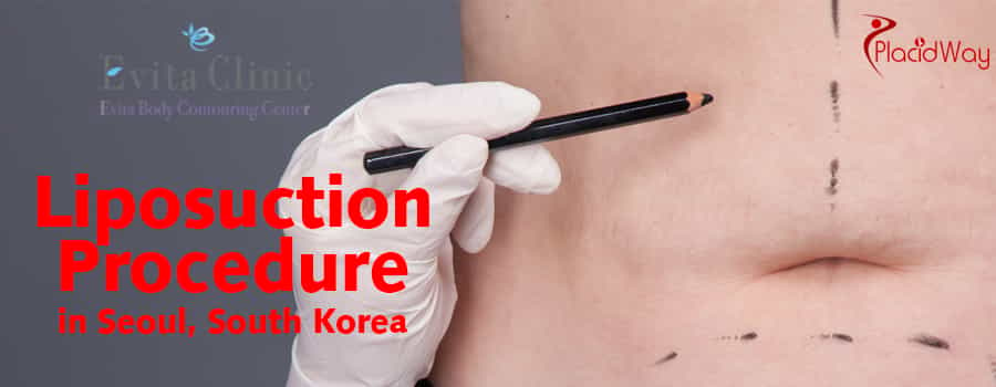 Liposuction Procedure in Seoul, South Korea