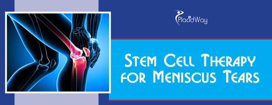 Stem Cell Therapy for a Meniscus Tear
