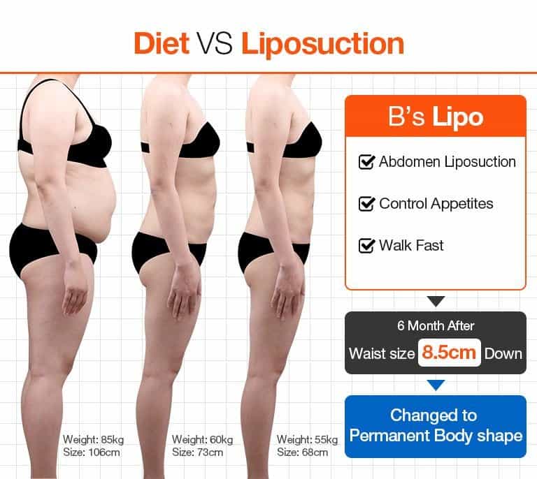 Diet Vs Liposuction