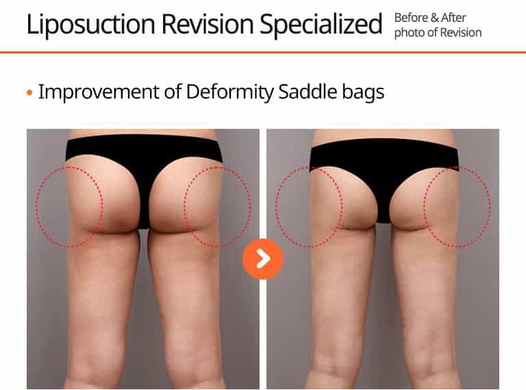 Liposuction Revision Specialized