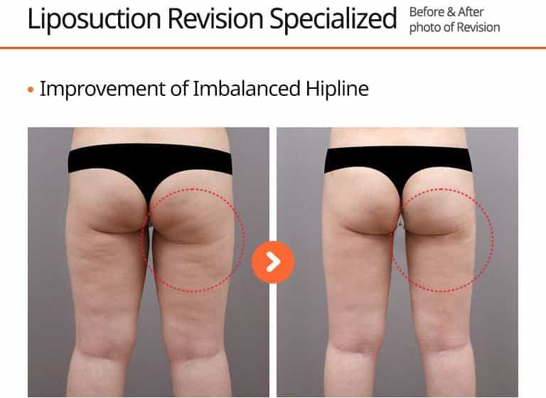 Liposuction Revision Specialized