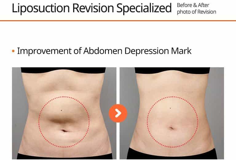 Liposuction Revision Specialized