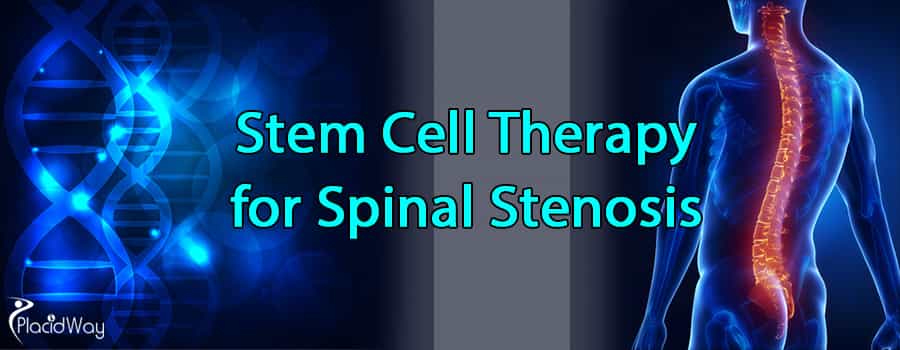 Stem Cell Therapy for Spinal Stenosis Abroad