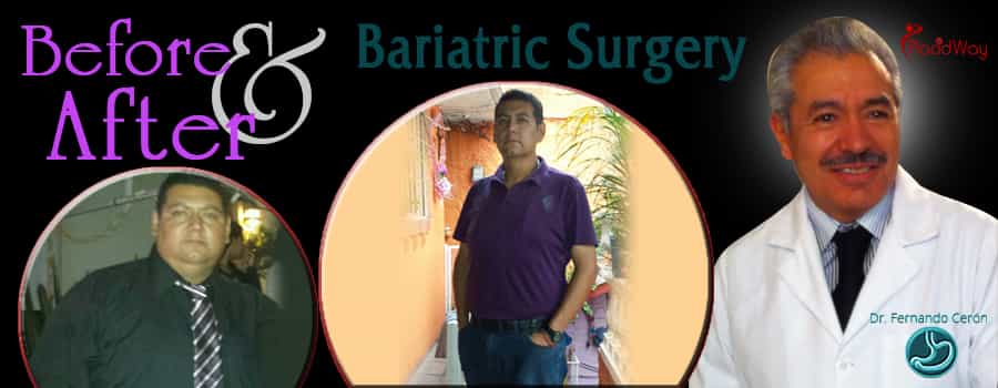 Patient Testimonials After Bariatric Surgery in Cancun, Mexico