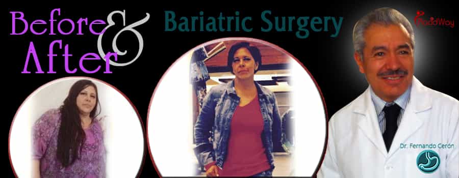 before after bariatric surgery in Mexico women after obesity procedure by Dr. Fernando Ceron