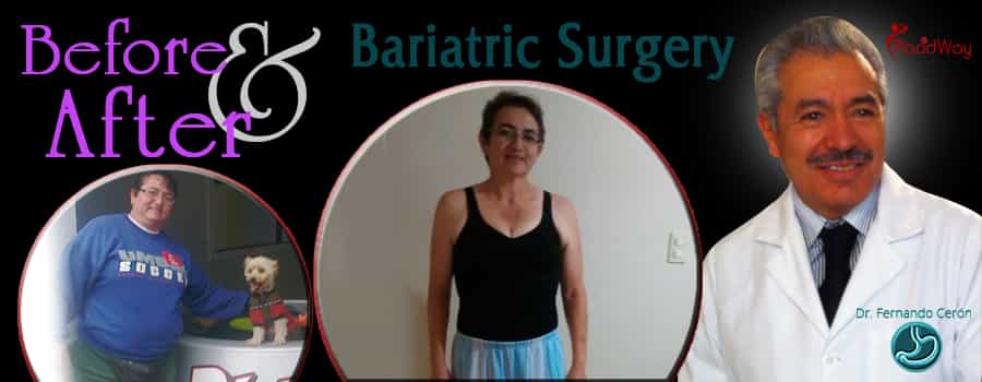 before after bariatric surgery in Mexico men image obesity procedure by Dr. Ceron Cancun, Mexico