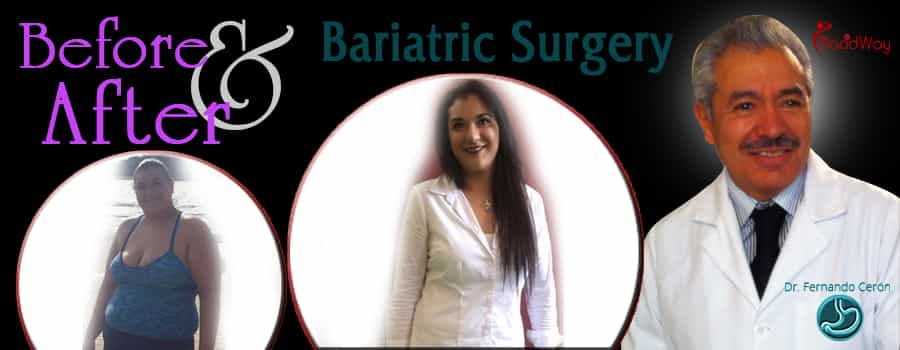 before after bariatric surgery in Cancun, Mexico