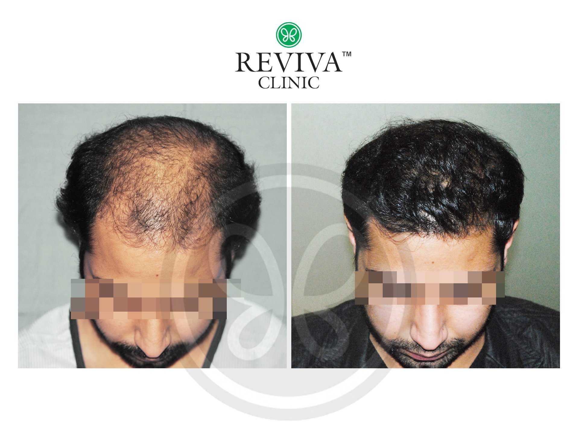 Reviva Before and After Hair Transplant 2