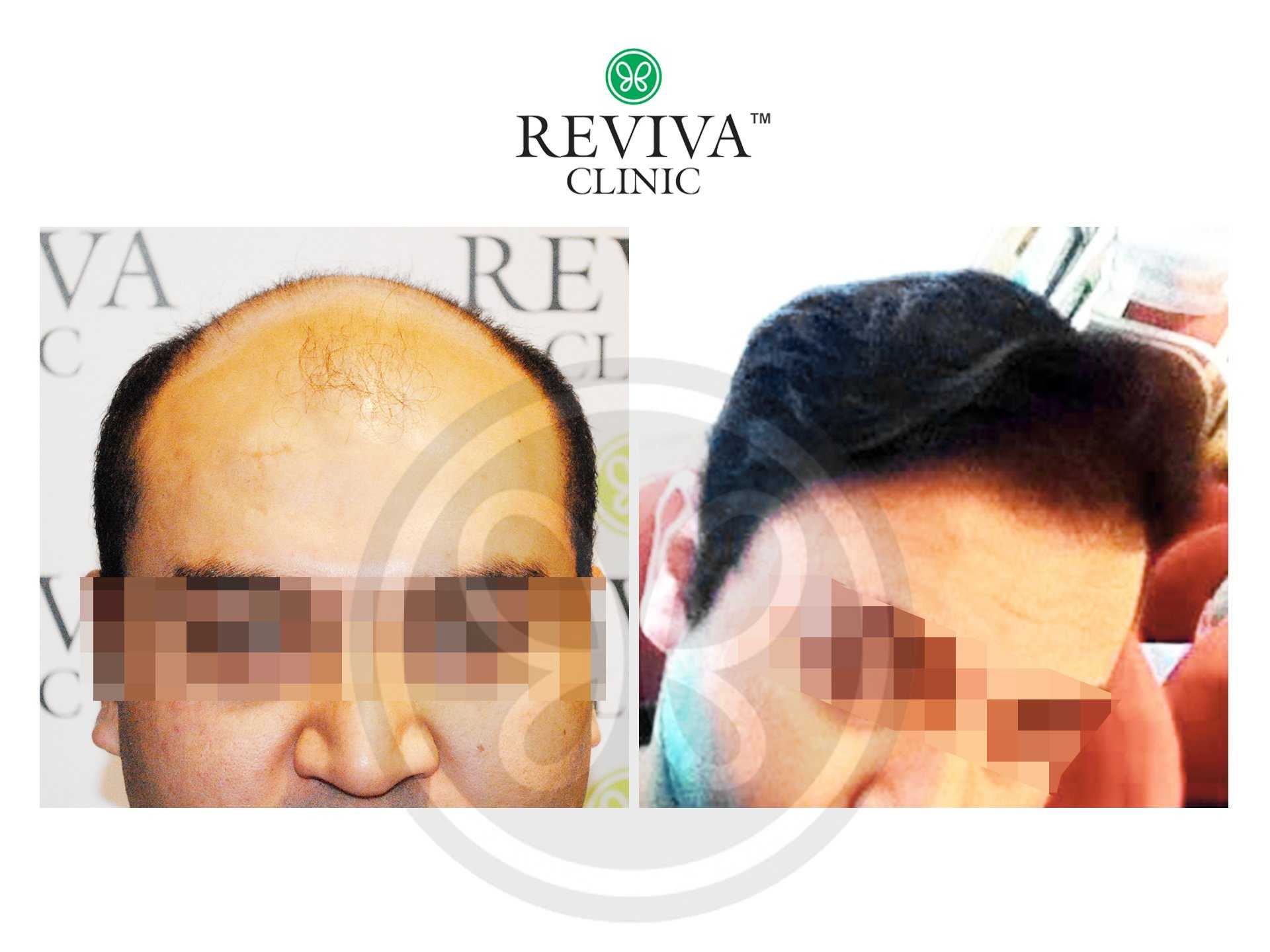 Reviva Before and After Hair Transplant 3