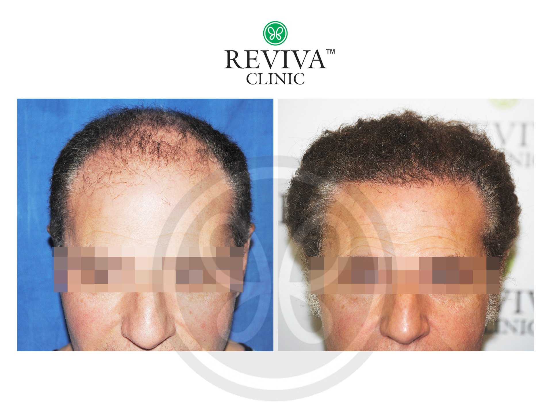 Reviva Before and After Hair Transplant 4