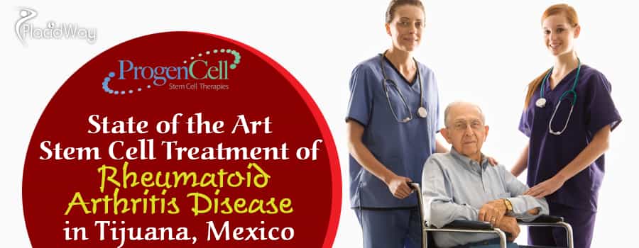 Stem Cell Treatment for Rheumatoid Arthritis in Tijuana, Mexico