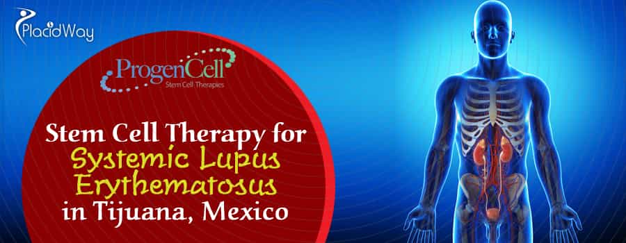 Systemic Lupus Erythematosus Stem Cell Therapy