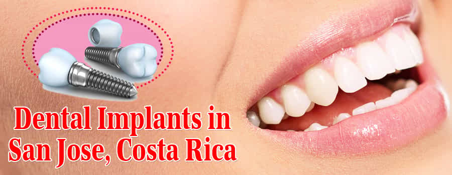 Dental Implants in San Jose, Costa Rica