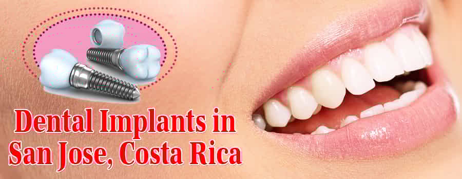 Dental Implants in San Jose, Costa Rica