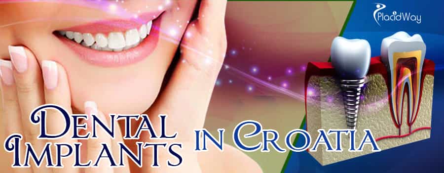 Best Dental Implants in Croatia