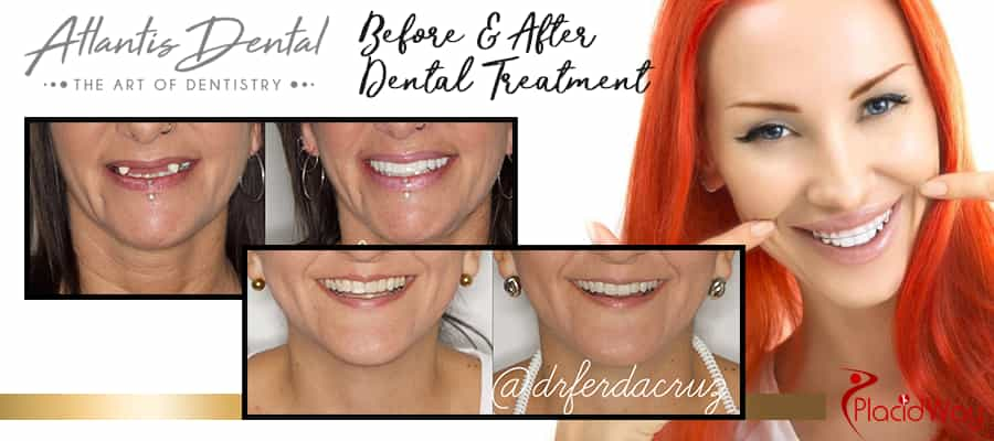 Before and After Dental Veneers in Costa Rica