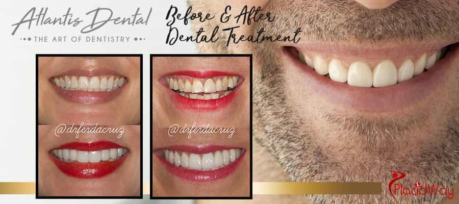 Before and After Image of Patient Atlantis Dental Costa Rica