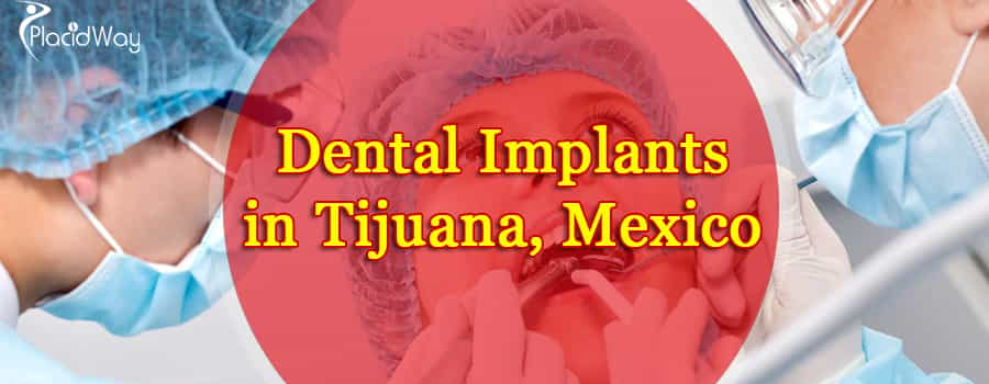 Best Dental Implant Dentists in Tijuana, Mexico
