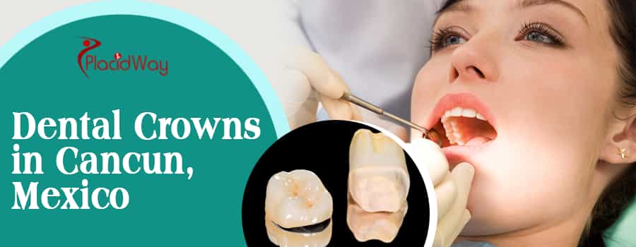 Dental Crowns in Cancun, Mexico
