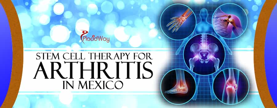 Stem Cell Therapy for Arthritis in Mexico