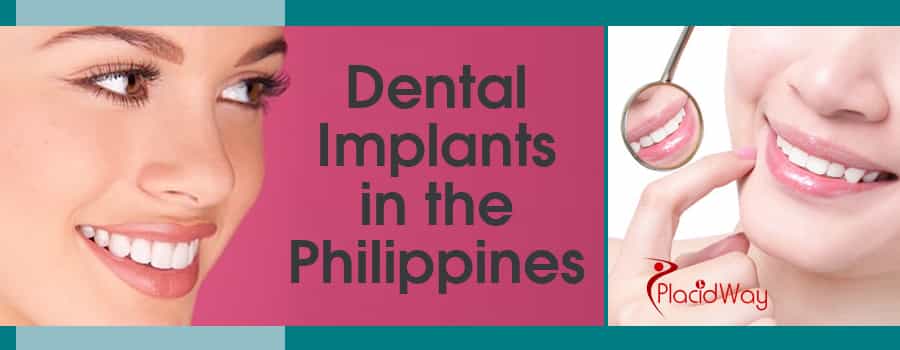 Dental Implants in Philippines