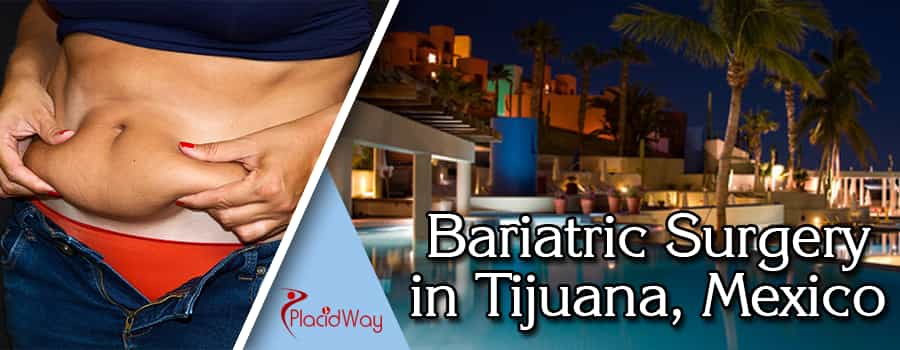 Bariatric Surgery in Tijuana, Mexico