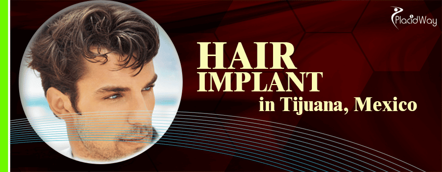 Hair Implant in Tijuana, Mexico