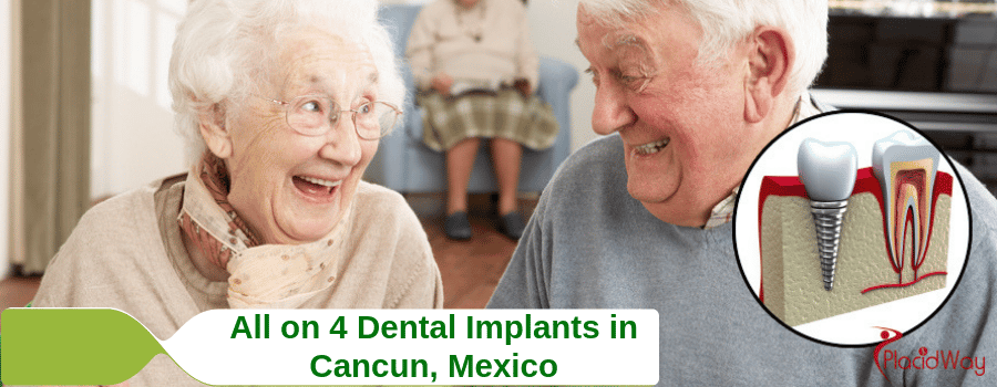 All on 4 Dental Implants in Cancun Mexico Costs