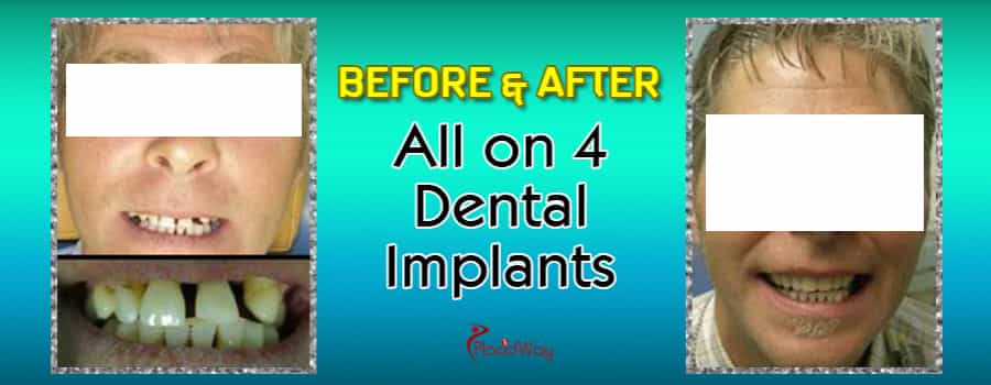 Before and After All on 4 Dental Implants in Mexico