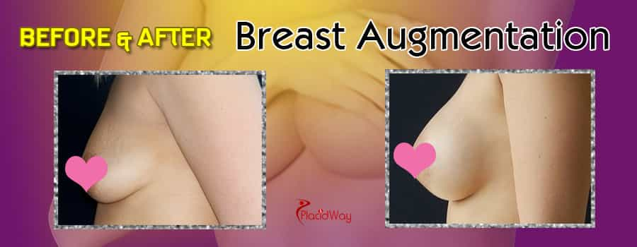 Before and After Breast Augmentation in Mexico