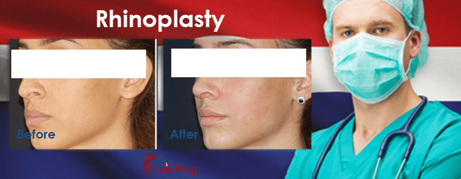 Rhinoplasty Before and After