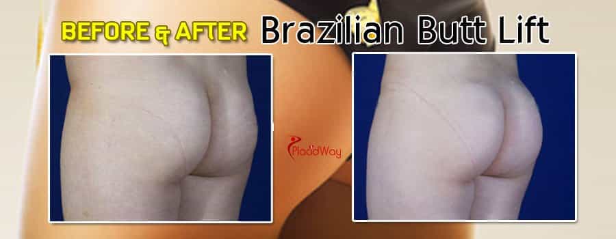 Brazilian Butt Lift in Turkey