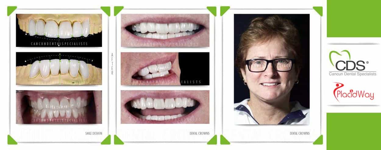 Before and After Dental Crowns in Cancun, Mexico