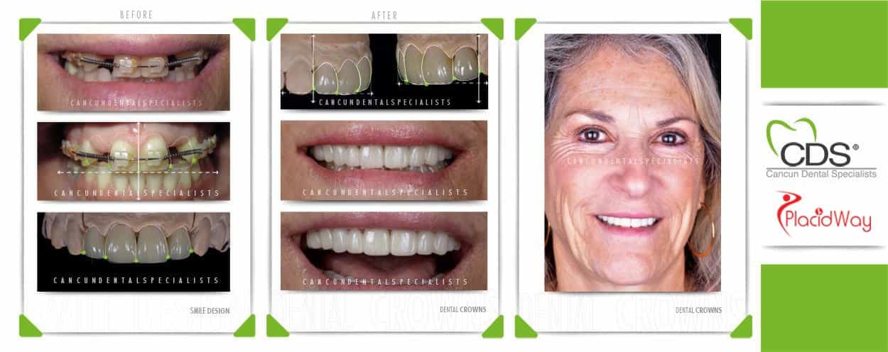Before and After Dental Crowns Treatment in Cancun, Mexico